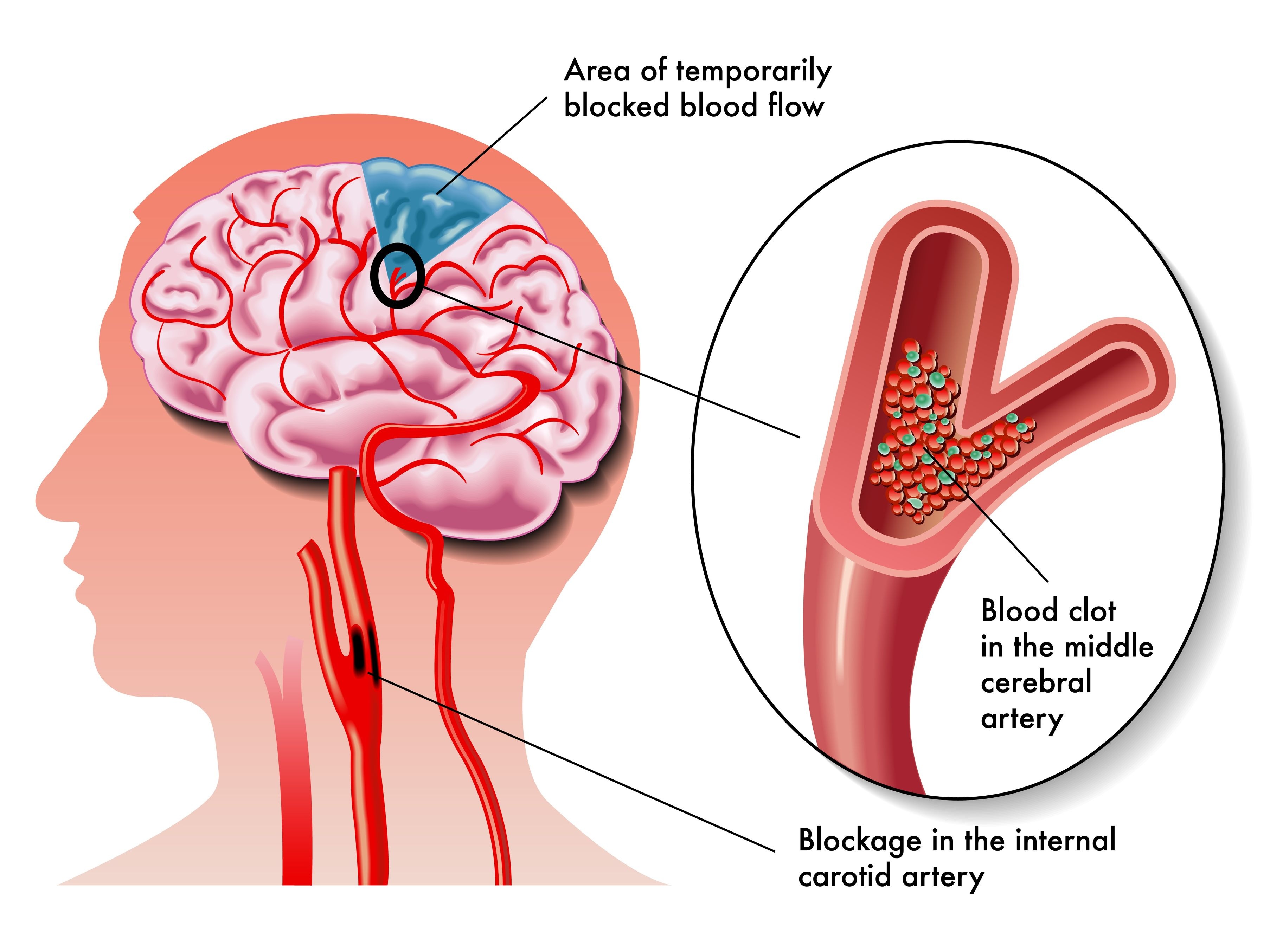 Болезни головных сосудов. Расширение сосудов головного мозга. Атеросклероз сосудов головного мозга. Атеросклероз мозговых артерий.